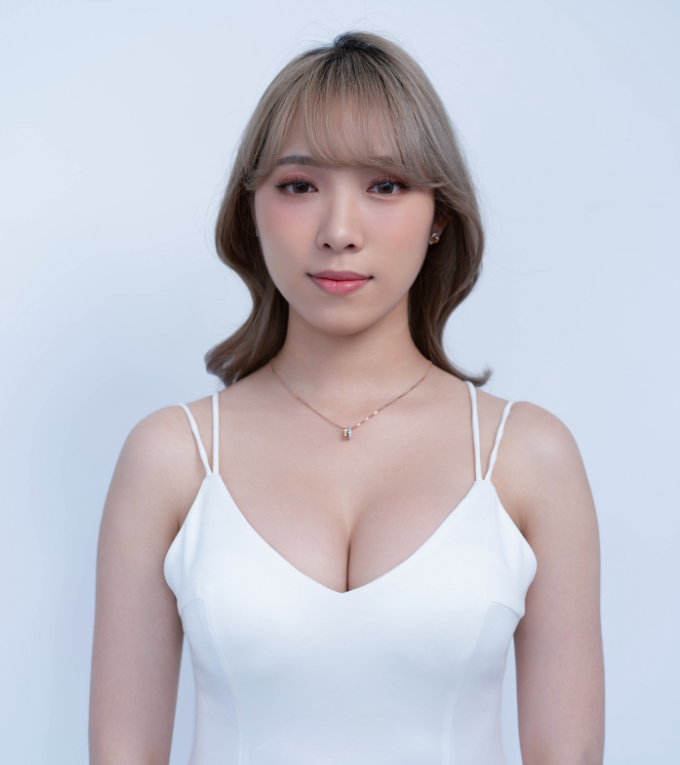 女神波隆乳術前術後-正面