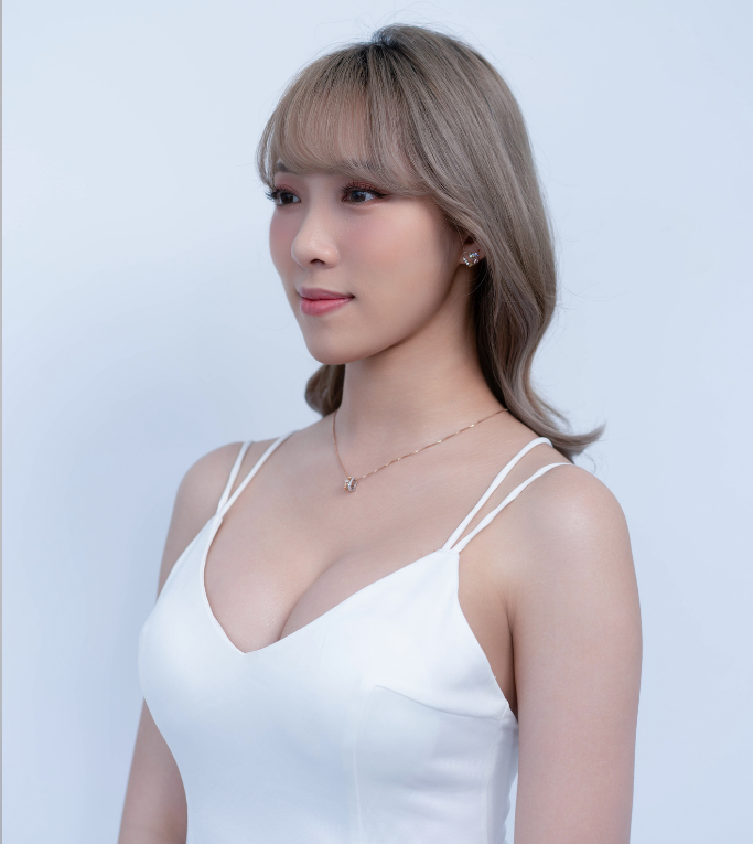 女神波隆乳術前術後-側面